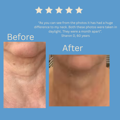 Before and after comparison of neck skin with text and star rating on a blue background